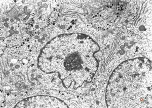 F, 51y. | acromegaly - acidophilic pituitary adenoma (STH) F, 51y. | acromegaly - acidophilic pituitary adenoma (STH)